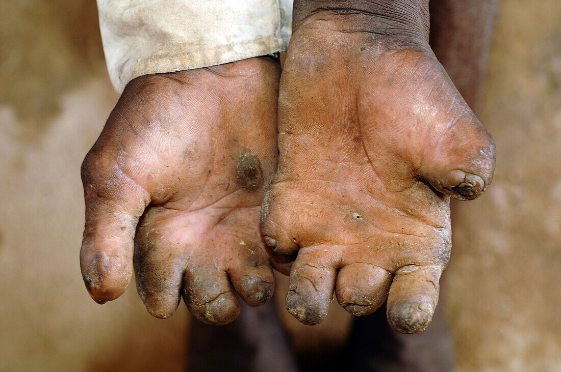 Leprosy