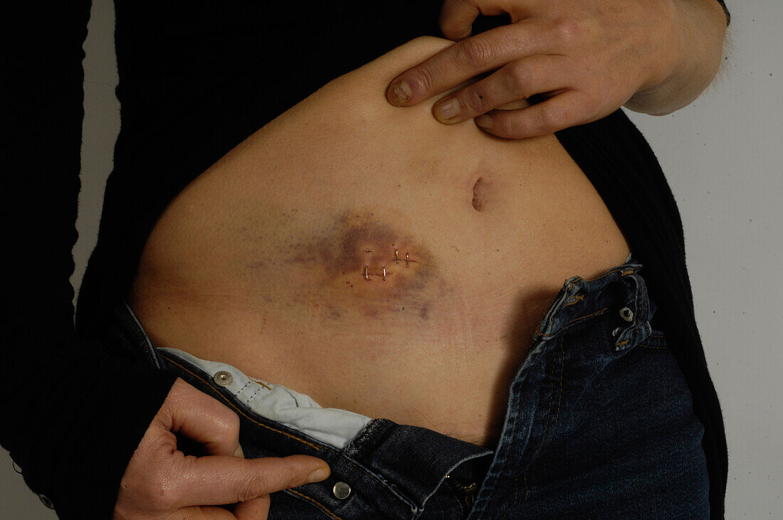 Knife wound and bruise of a self harm victim