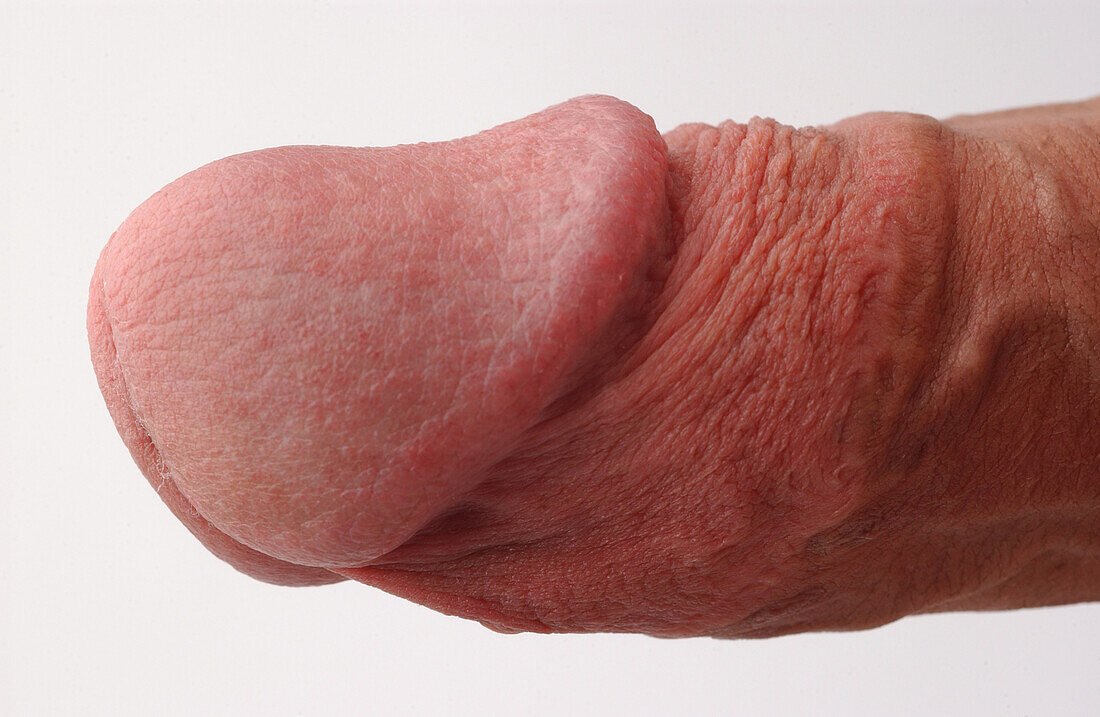 Erect penis of a circumcised man