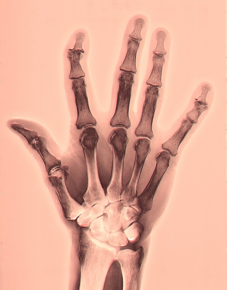 Arthritic hand, X-ray