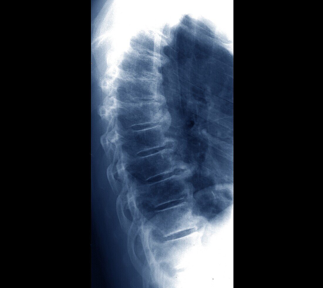 Back pain, X-ray