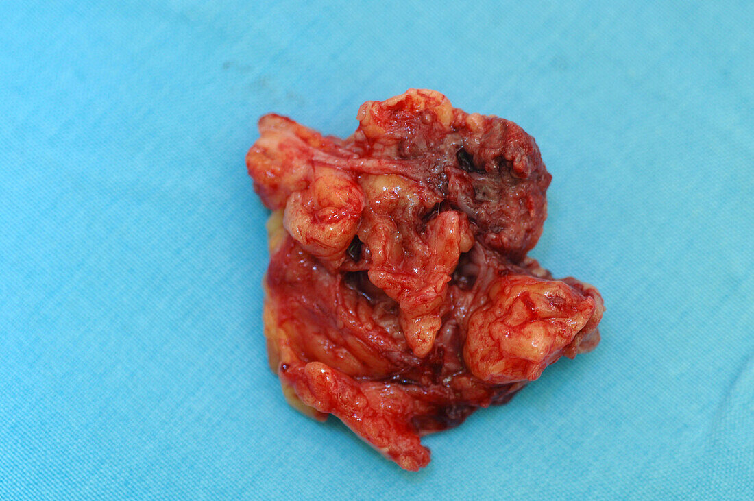 Excised mammary duct