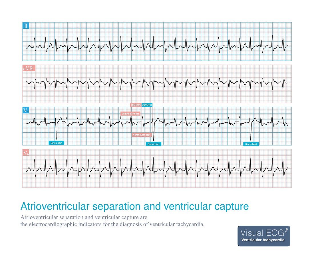 Atrioventricular separation and ventricular capture