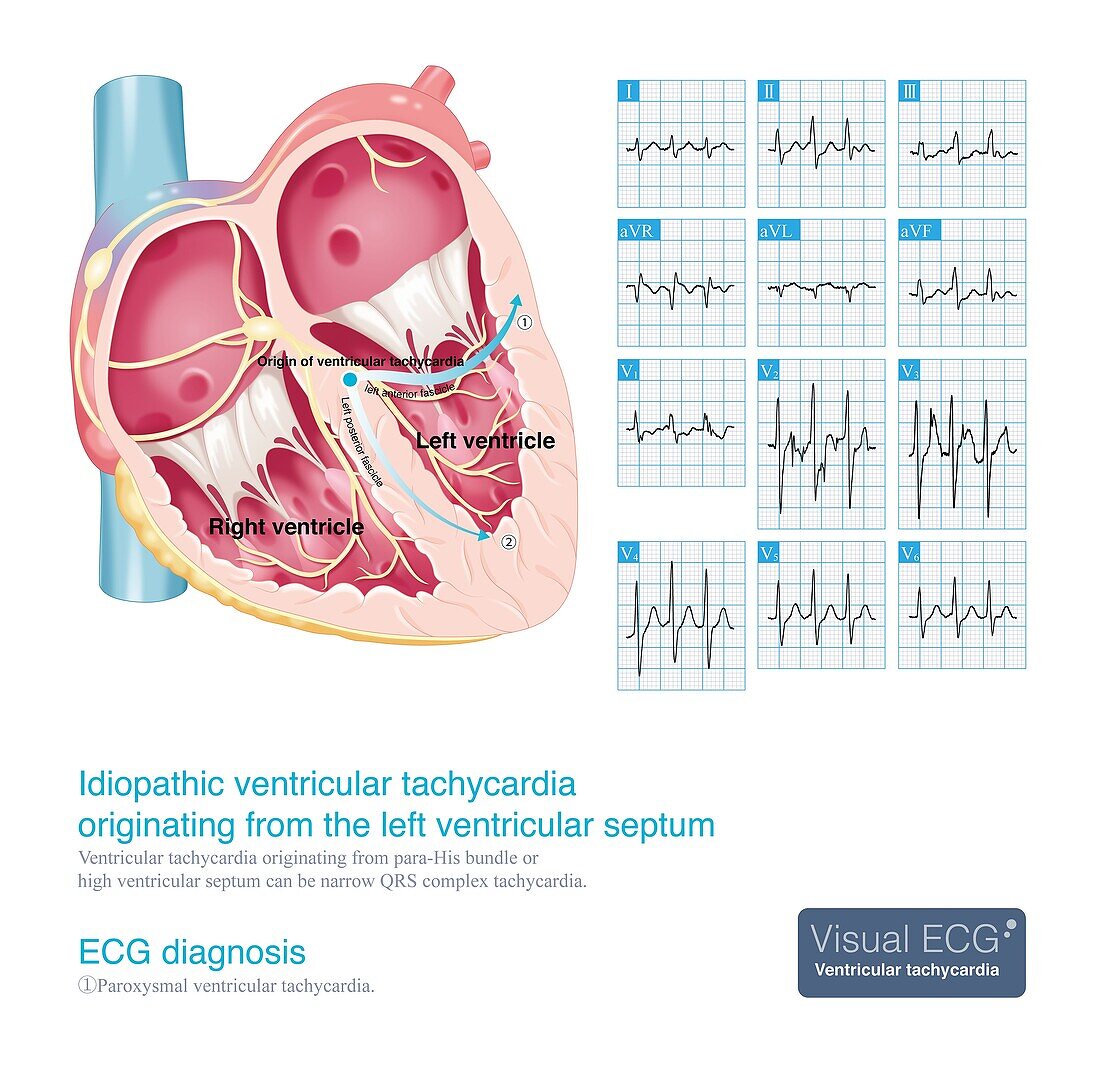 Idiopathic ventricular tachycardia, illustration