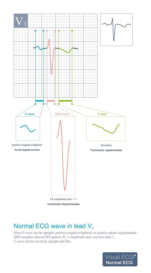 Normal ECG wave in lead V1, illustration