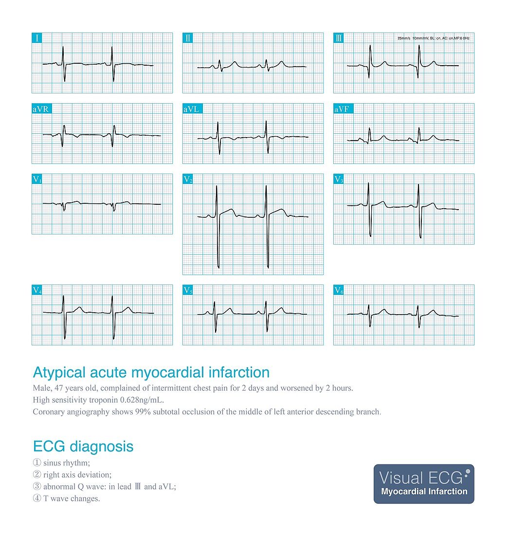 Atypical acute myocardial infarction, illustration