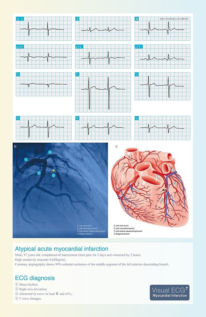 Acute coronary syndrome, illustration