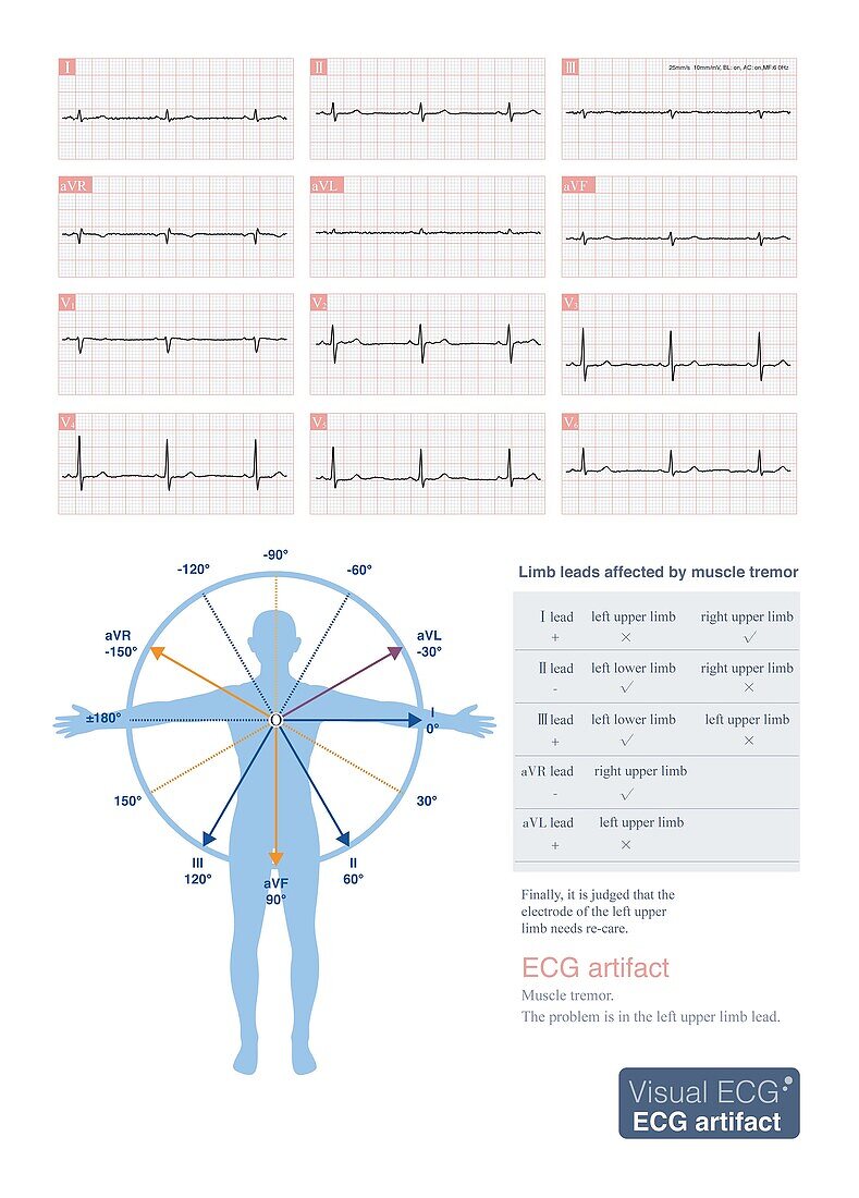 Limb lead muscle tremor on ECG, illustration