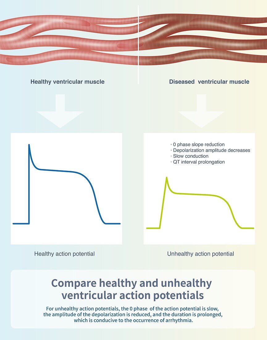 Healthy and unhealthy ventricular action potentials