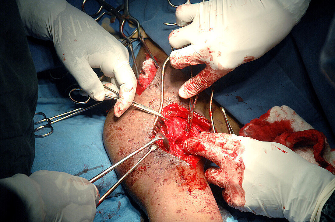 Axillary artery aneurysm repair