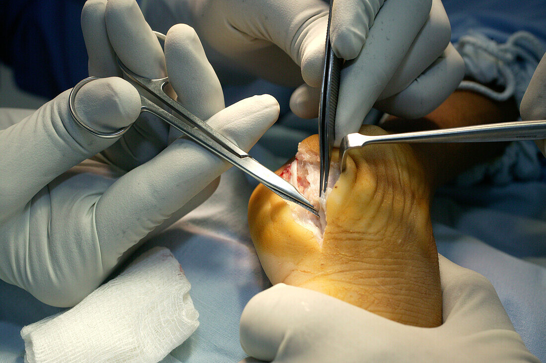 Foot reconstruction surgery