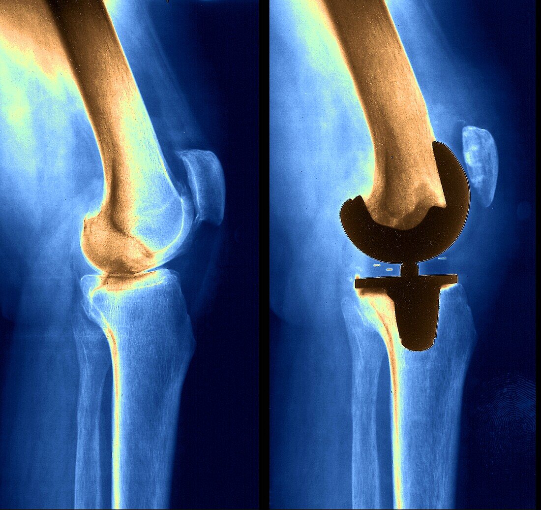 Knee replacement, X-ray
