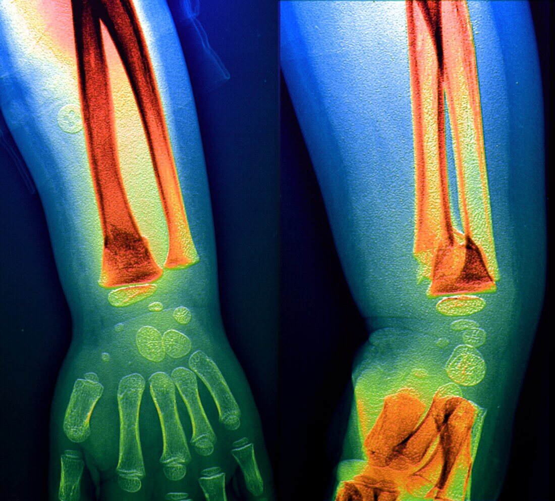 Fractured radius bone, X-ray