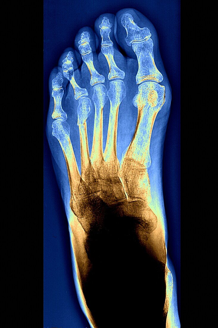 Fractured metatarsal foot bone, X-ray