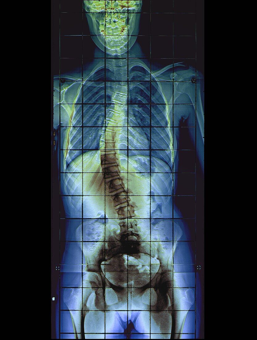 Scoliosis, X-ray