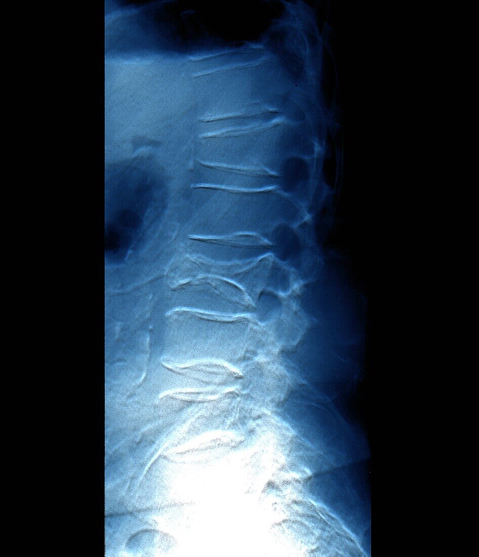 Osteoporosis, X-ray