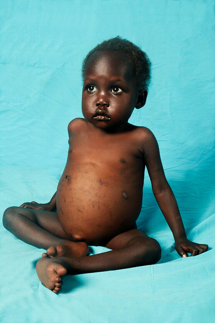 Child with hepatosplenomegaly