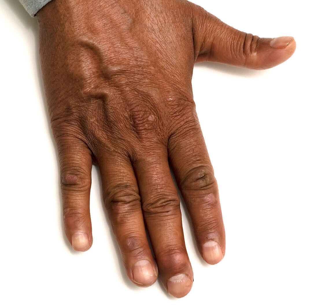 Healed ulcers on hand of leprosy patient