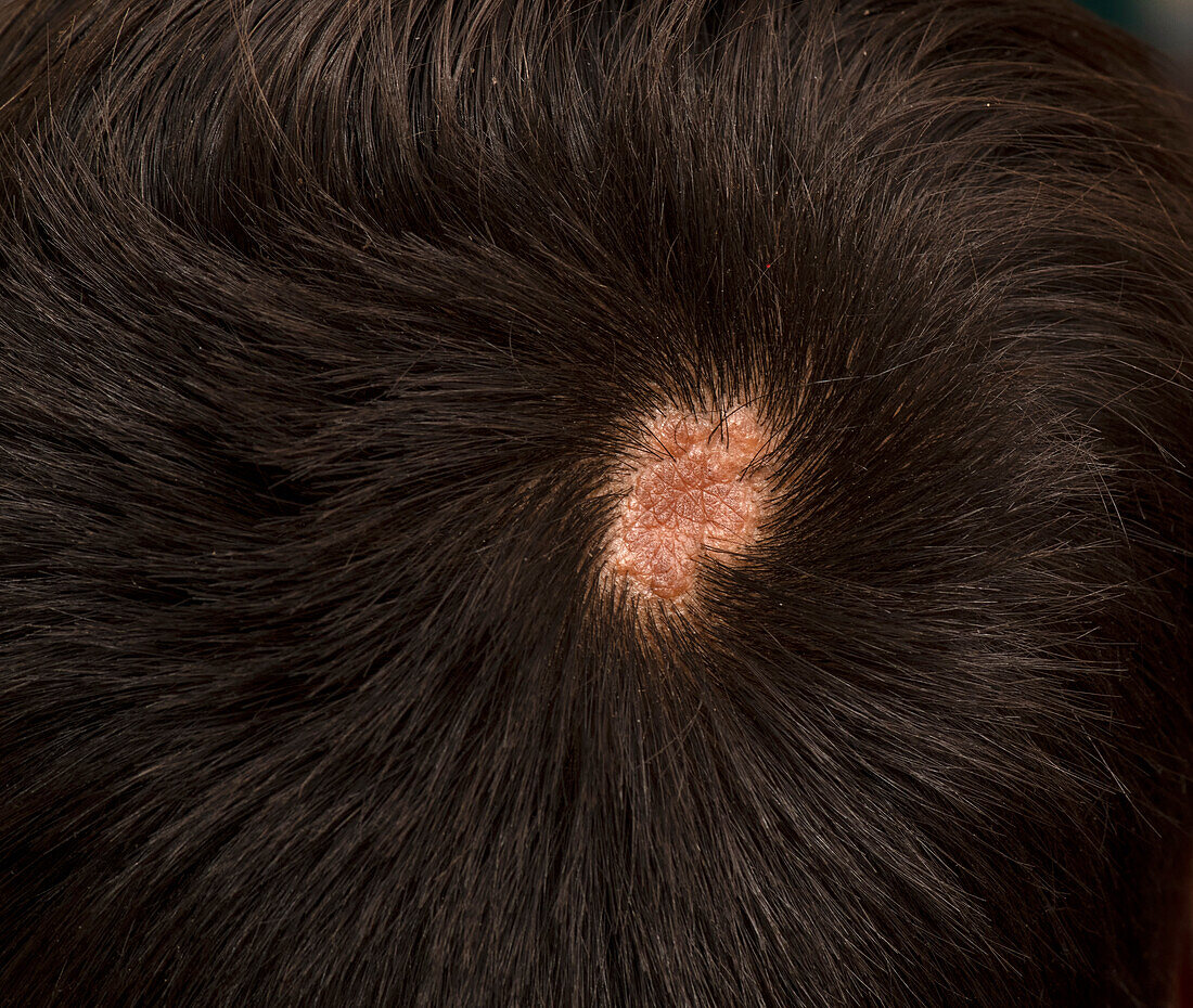 Post inflammatory pemphigoid on the scalp