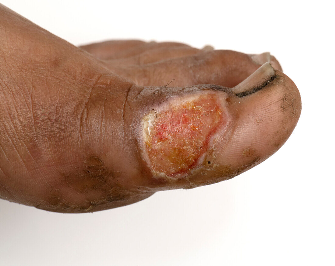 Foot ulcer following burn