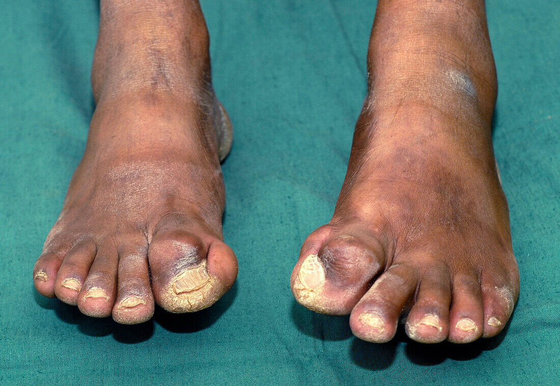 Big toe deformity
