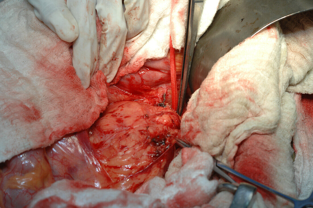 Complete opening of the peritoneum