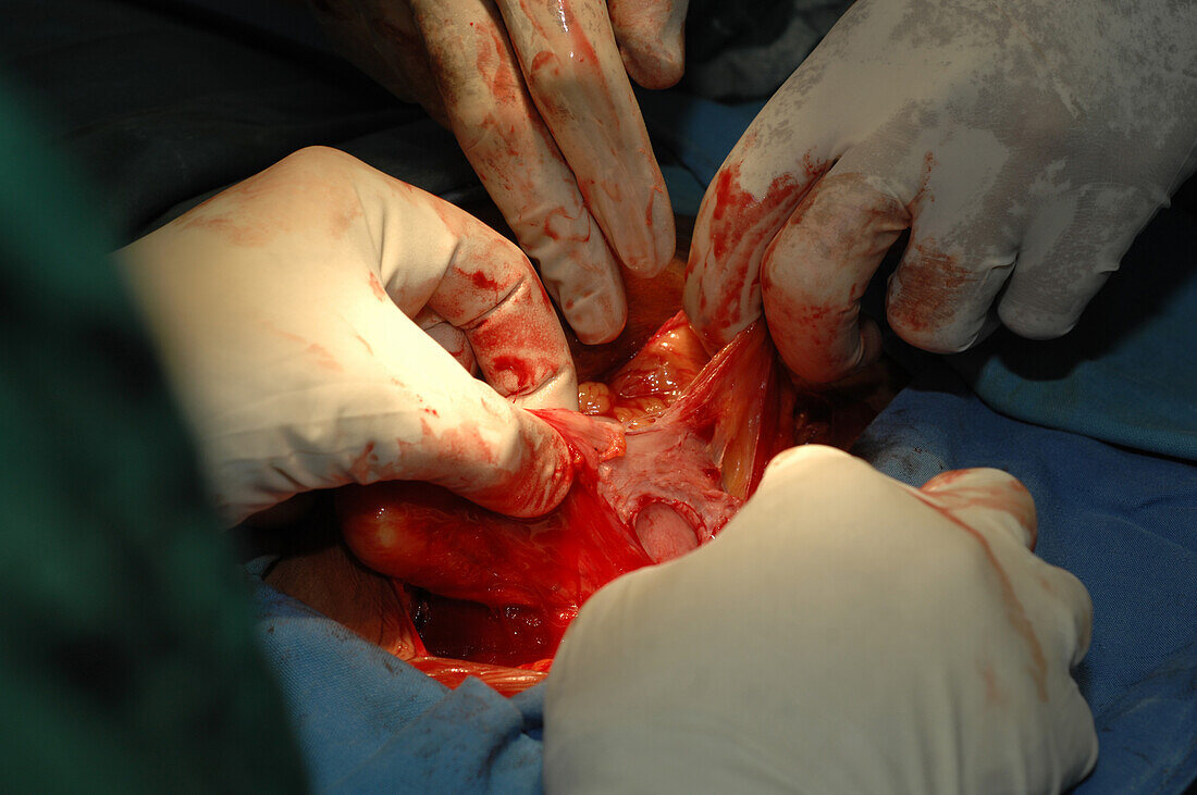 Uterine fibroid surgery
