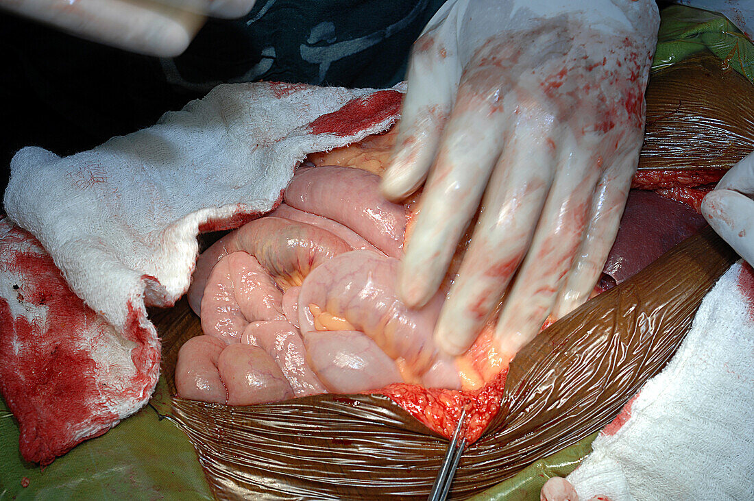 Normal bowel loops