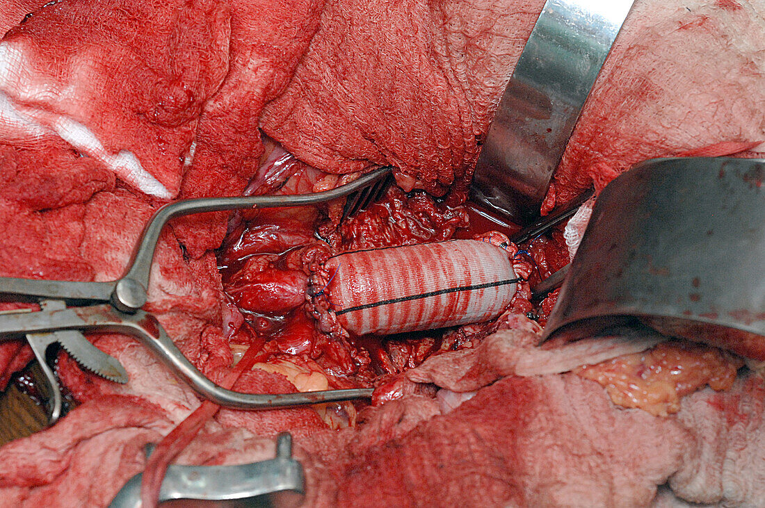 Abdominal aortic aneurysm surgery