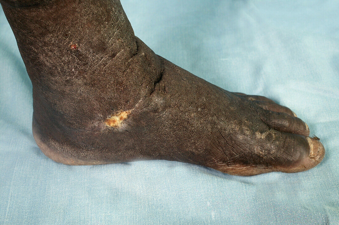 Varicose vein