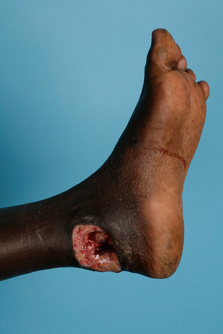 Patient with mycetoma