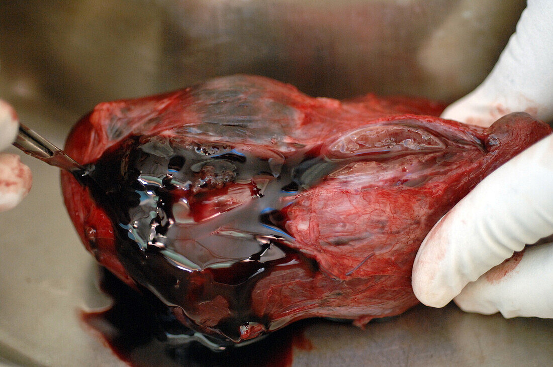 Excised goitre being dissected by a surgeon