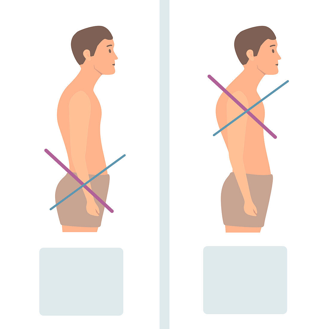 Upper and lower crossed syndromes, conceptual illustration