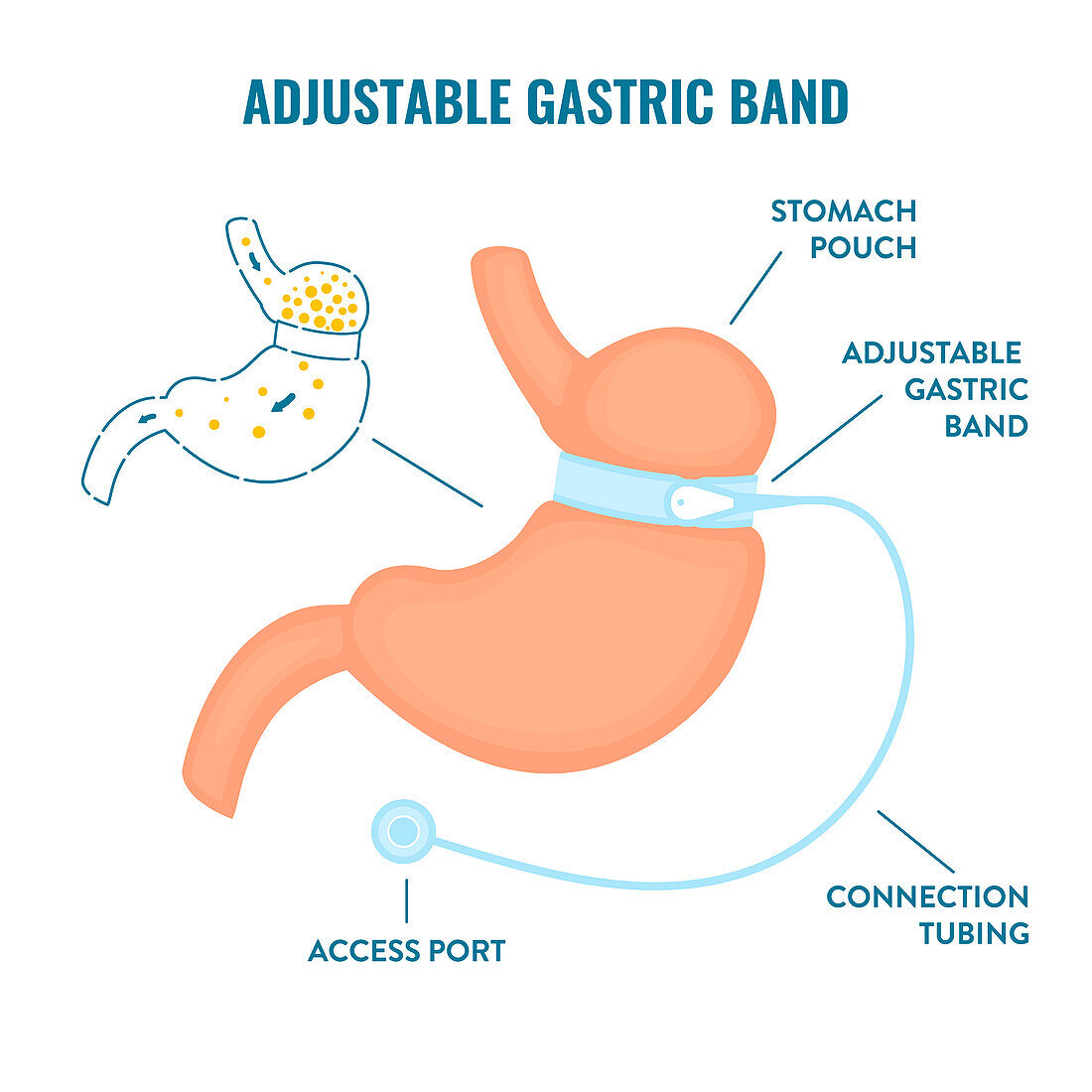 Adjustable gastric band bariatric surgery, illustration