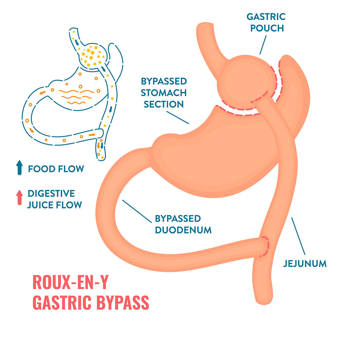 Roux-en-Y gastric bypass bariatric surgery, illustration