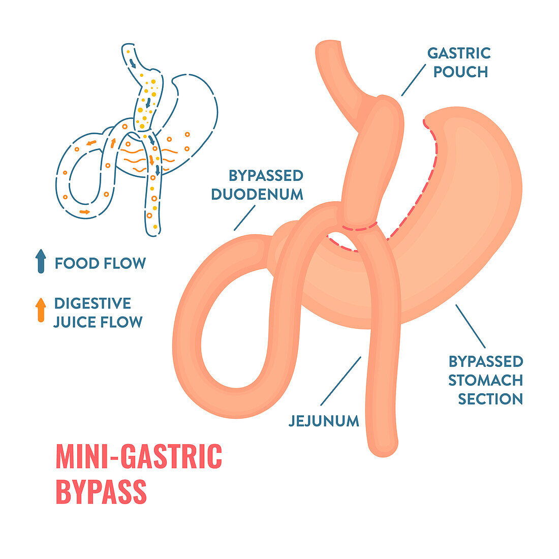 Mini gastric bypass bariatric surgery, illustration