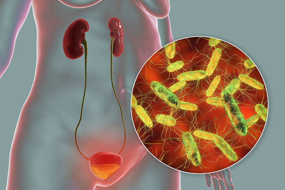 Bacterial cystitis, illustration