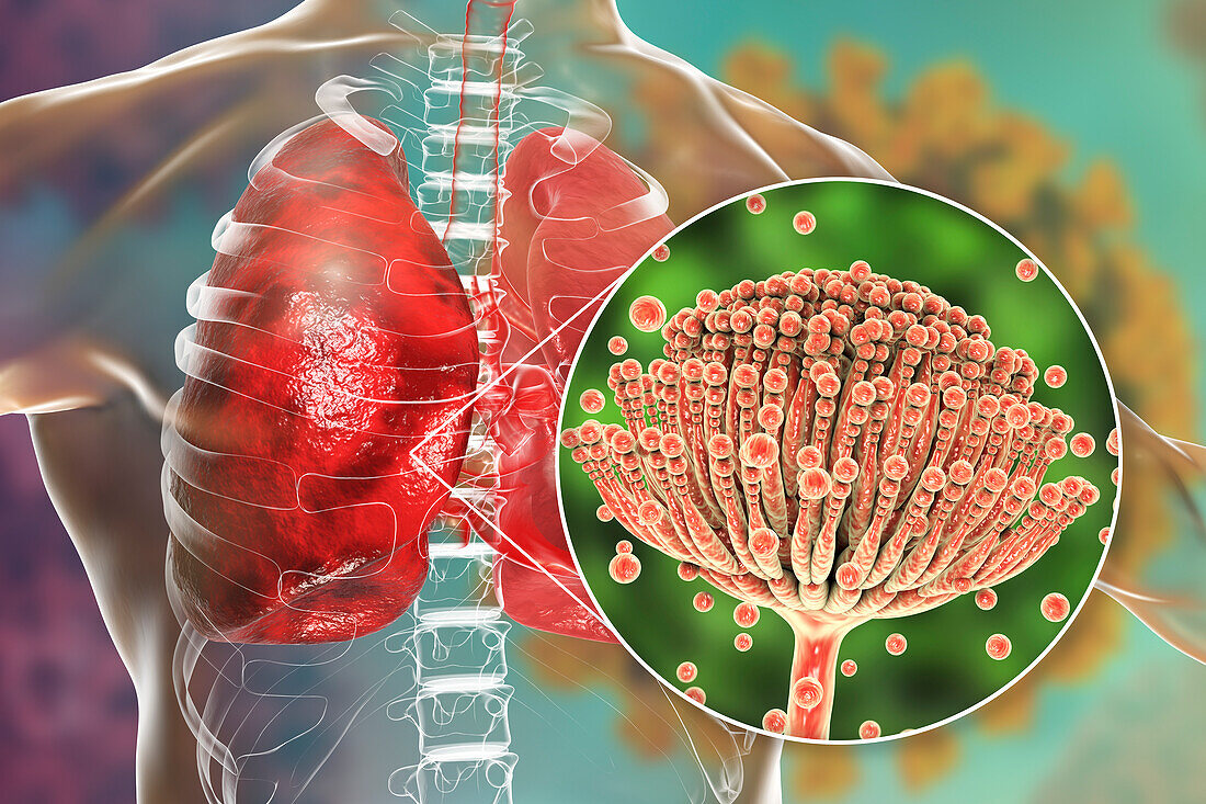 Pulmonary aspergillosis, illustration