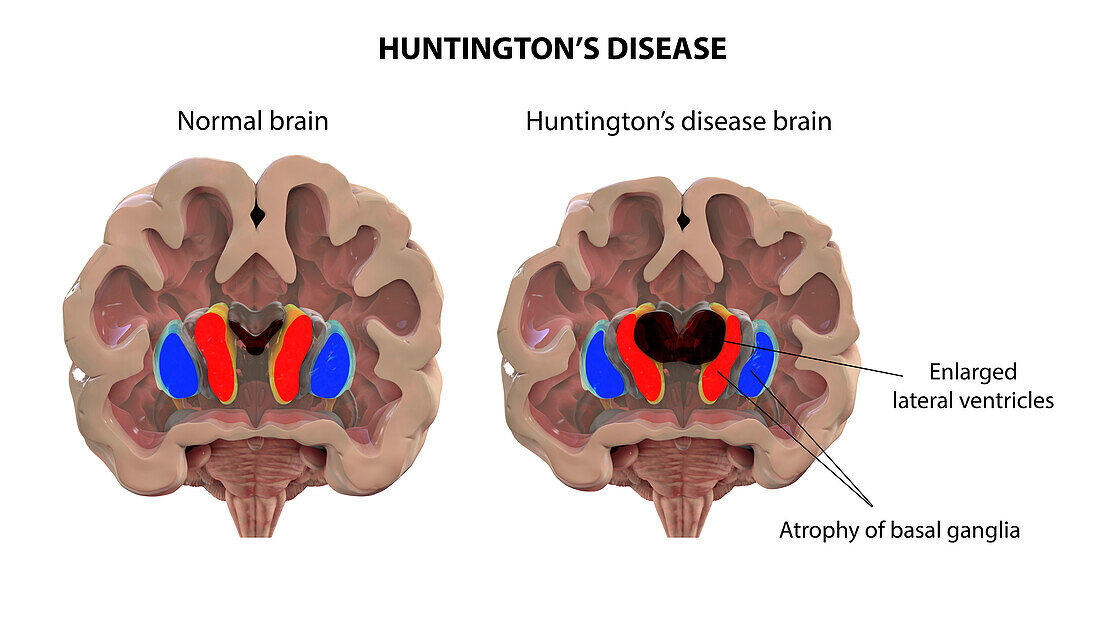 Normal brain and brain in Huntington's disease, illustration