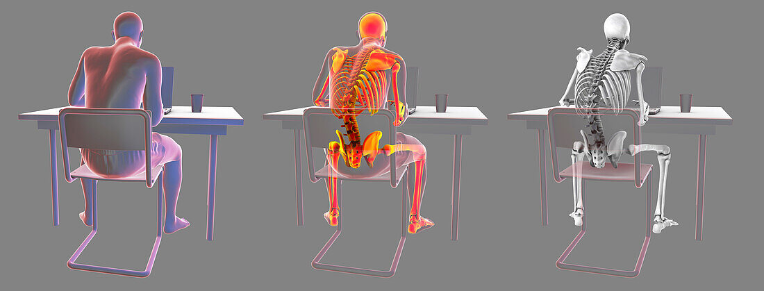 Bad posture whilst using laptop, illustration