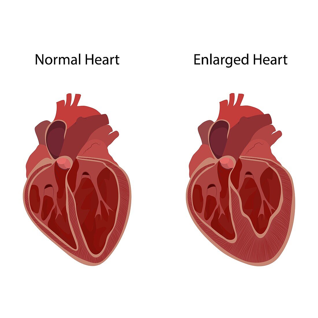 Normal and enlarged heart, illustration