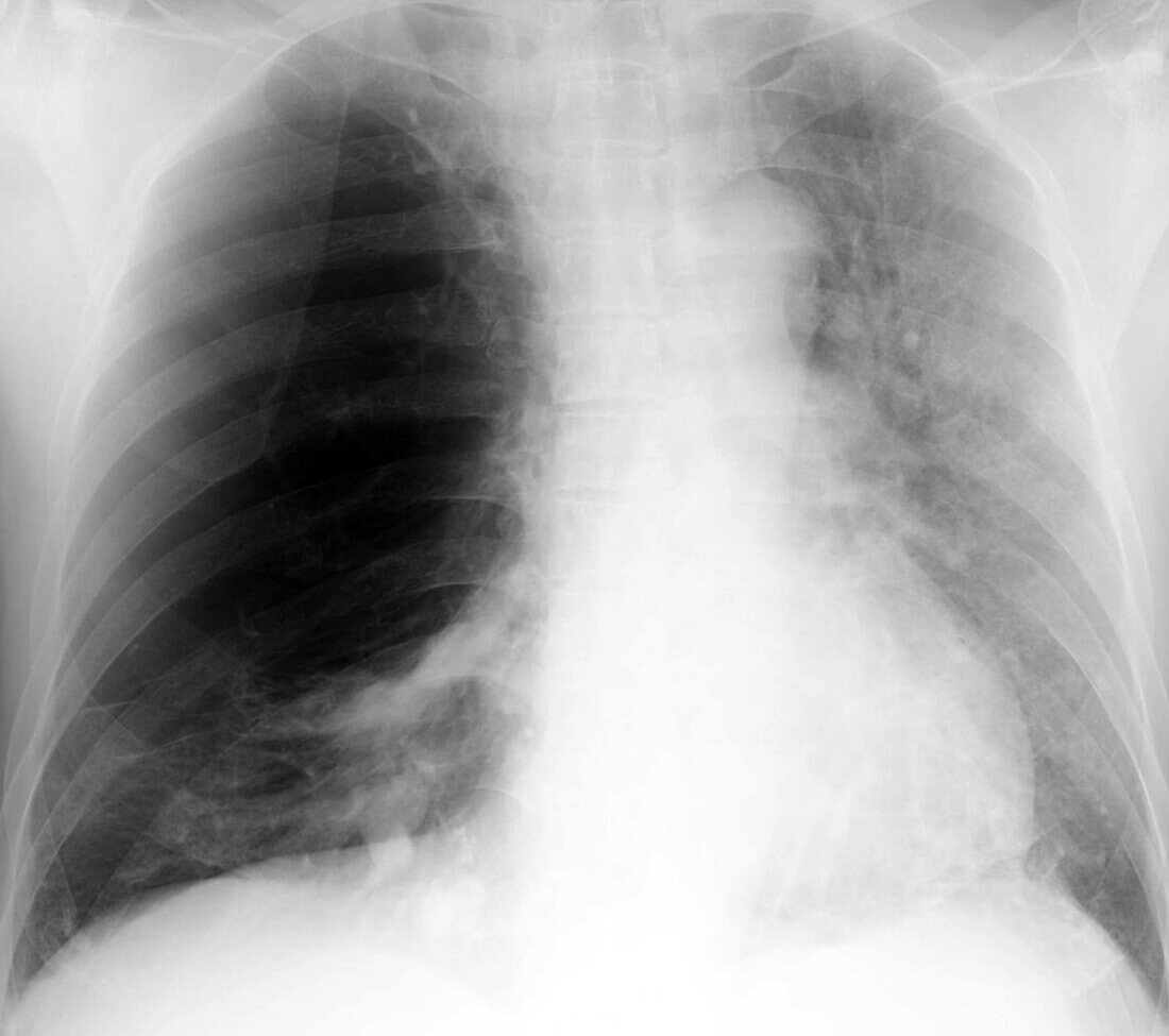 Pulmonary giant bulla, X-ray