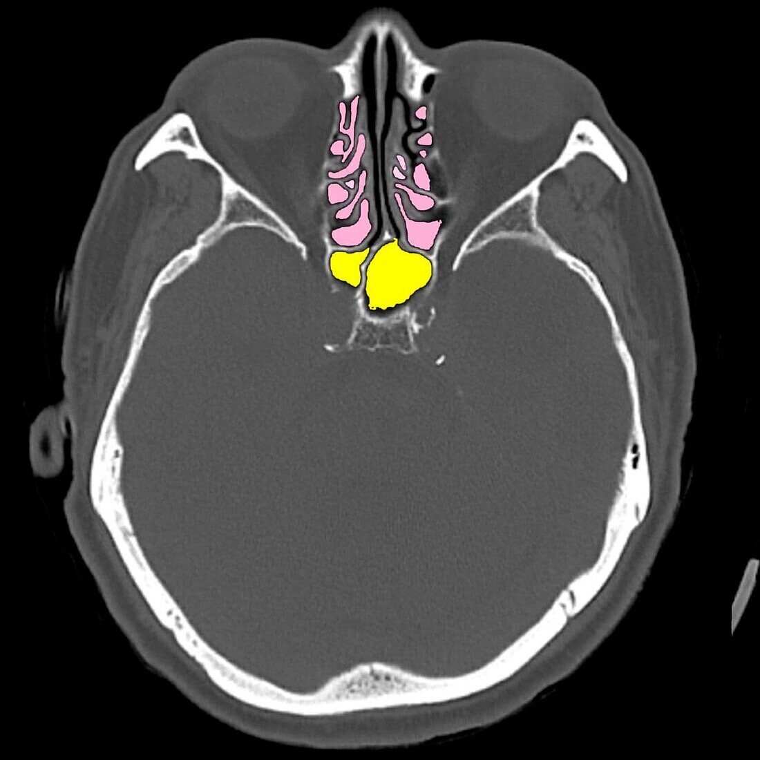 Paranasal sinus anatomy, CT scan