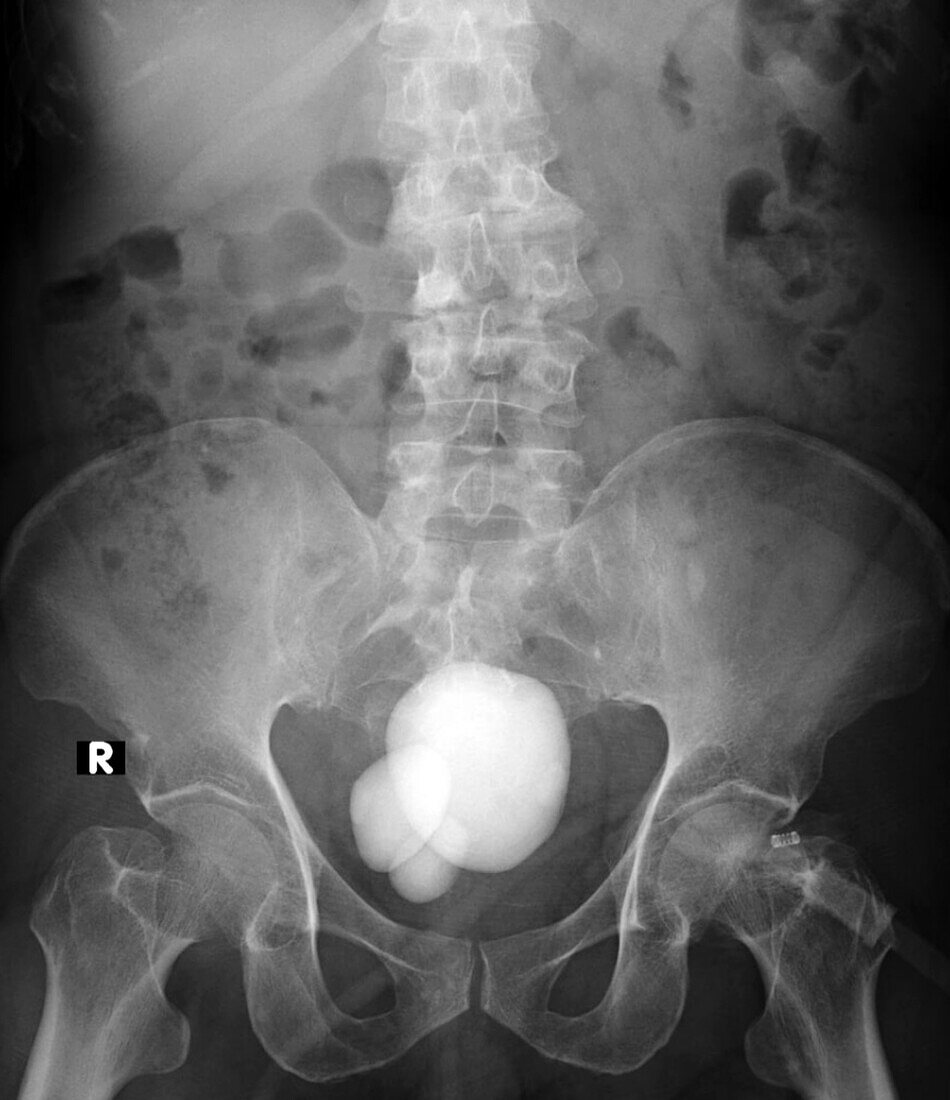 Vesicolithiasis, X-ray