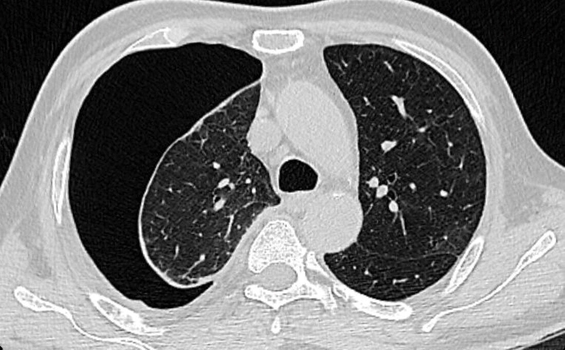 Pneumothorax, CT scan