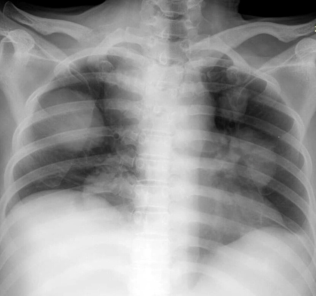 Secondary lung cancer, X-ray
