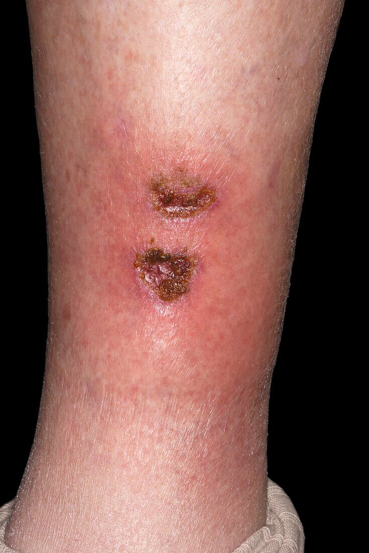 Infected wound on leg