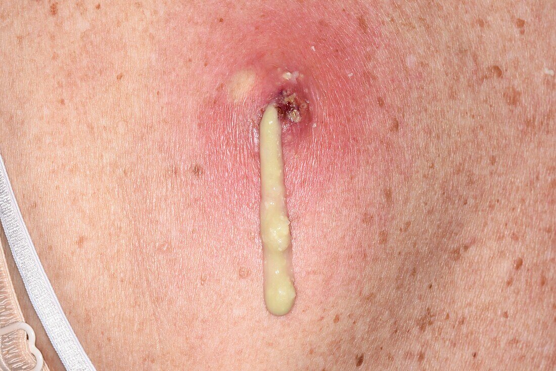 Draining of a sebaceous cyst