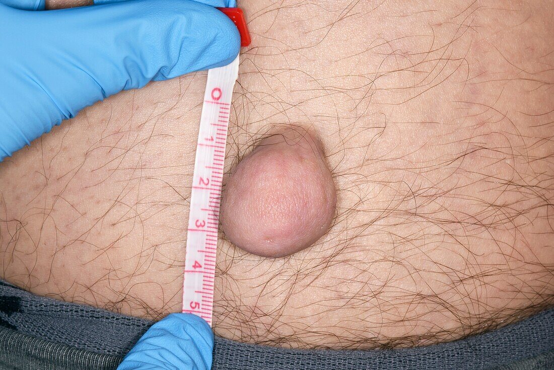Fibroepithelial polyp being measured