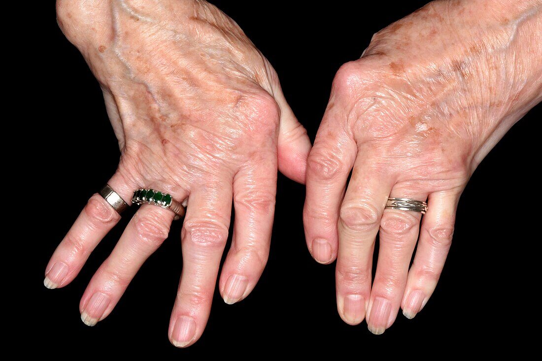 Rheumatoid arthritis